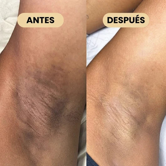 DESODORANTE DESPIGMENTANTE ━ Con Ácido Kójico y Cúrcuma.