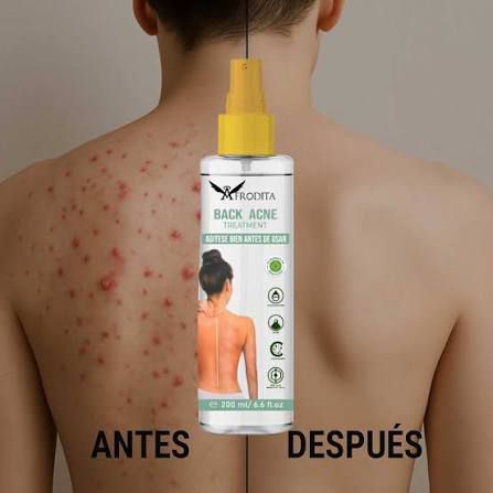 BACK ACNE - Tratamiento corporal anti-acne.